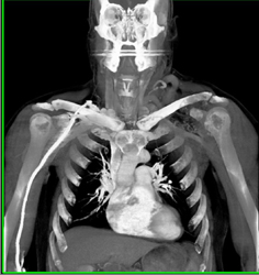 Arteriovenous Malformation (AVM) Left Supraclavicular Zone - CTisus CT Scan