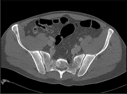 Metastases to Acetabulum - CTisus CT Scan