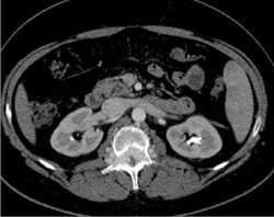 Arteriovenous Malformation (AVM) in Spine - CTisus CT Scan