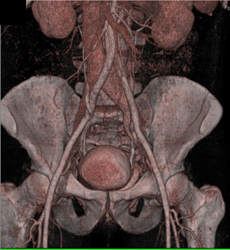 Pelvic Arteriovenous Malformation (AVM) - CTisus CT Scan