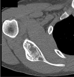 Fibrous Dysplasia of the Scapula - CTisus CT Scan