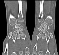 Prior Pinning of Fracture - CTisus CT Scan