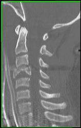 C-4 Fracture - CTisus CT Scan