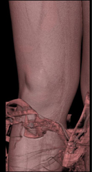 Prior Repair of Meniscal Tear With Clip Seen - CTisus CT Scan