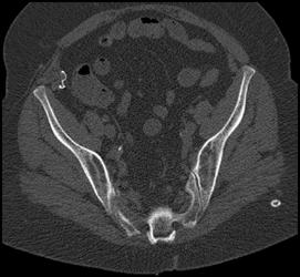 Retained Sponge RLQ - CTisus CT Scan