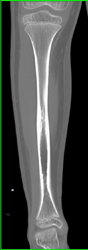 Stress Fracture - CTisus CT Scan