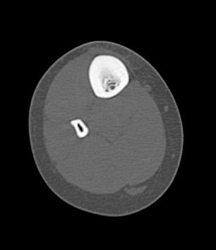 Stress Fracture - CTisus CT Scan