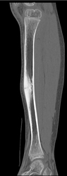 Stress Fracture - CTisus CT Scan