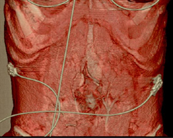 Dehisence of Muscle in Midline - CTisus CT Scan