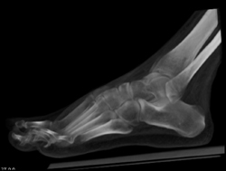 Bone Editing Tool Removes the Talus - CTisus CT Scan