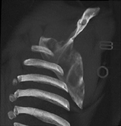 Scapular Fracture Through Benign Cyst - CTisus CT Scan