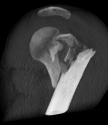 Humerus Fracture Impacted on the Glenoid - CTisus CT Scan