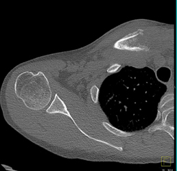 Erosion of S/c Joint With Infection - CTisus CT Scan