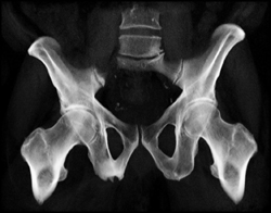 Avulsion Injury Off Right Ischium - CTisus CT Scan