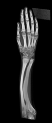 Osteogenesis Imperfecta - CTisus CT Scan