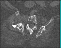 Osteogenesis Imperfecta - CTisus CT Scan