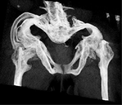 Osteogenesis Imperfecta - CTisus CT Scan