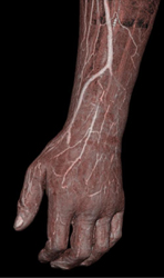 CTA of the Hand for Abscess - CTisus CT Scan