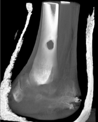 Brodios Abscess With Ankle Fusion - CTisus CT Scan