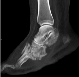 Charcot Joint - CTisus CT Scan