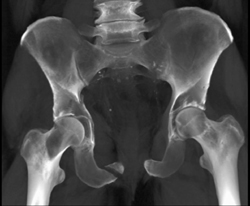 Acetabular Fracture and Symphysis Fracture - CTisus CT Scan