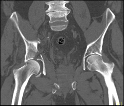 Acetabular Fracture - CTisus CT Scan