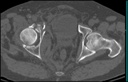 Acetabular Fracture - CTisus CT Scan