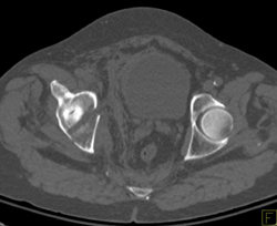 Acetabular Fracture - CTisus CT Scan