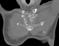 Metastases to Sternum - CTisus CT Scan