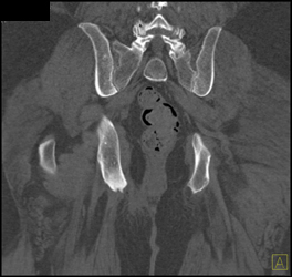 Chronic Osteomyelitis Ischum - CTisus CT Scan