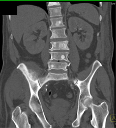 Blastic Bone Mets - CTisus CT Scan