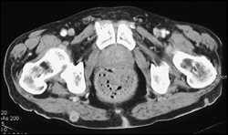 Metastatic Melanoma to Muscle - CTisus CT Scan