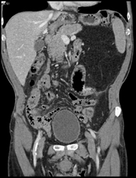 Liposarcoma Left Upper Quadrant - CTisus CT Scan