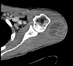 Intramuscular Abscess - CTisus CT Scan