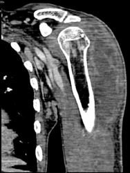 Intramuscular Abscess - CTisus CT Scan