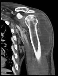 Intramuscular Abscess - CTisus CT Scan