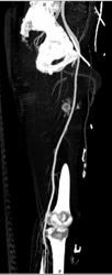 Contrast Extravasation S/P GSW - CTisus CT Scan