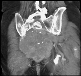 Chordoma - CTisus CT Scan