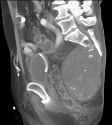 Chordoma - CTisus CT Scan