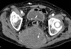 Chordoma - CTisus CT Scan