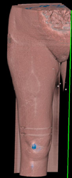 S/P Open Reduction Internal Fixation (ORIF) - CTisus CT Scan