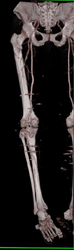 Run Off Study S/P Open Reduction Internal Fixation (ORIF) - CTisus CT Scan