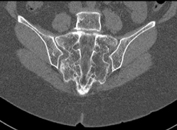 Osteoporosis With Sacral Stress Fracture - CTisus CT Scan