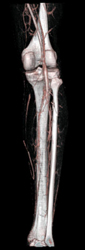 Trifurcation Patent S/P Trauma - CTisus CT Scan