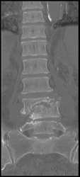 Osteomyelitis - CTisus CT Scan