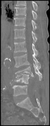 Osteomyelitis - CTisus CT Scan