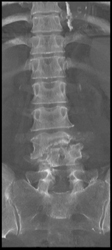 Osteomyelitis - CTisus CT Scan