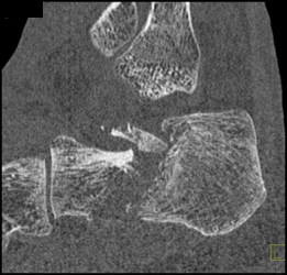 Calcaneal Fracture - CTisus CT Scan