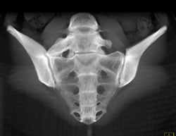 Sacralization of L-5 - CTisus CT Scan