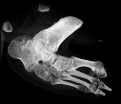 4 Toes - CTisus CT Scan